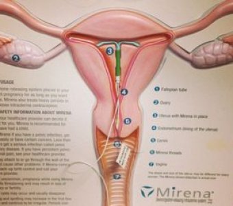Преимущества спирали Мирена