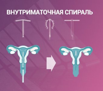 Как выбрать внутриматочную спираль